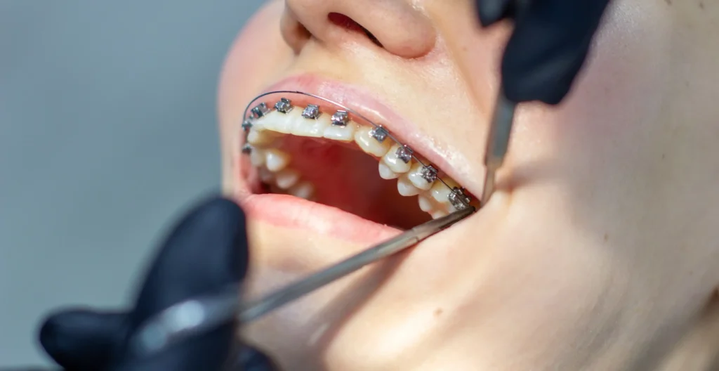 تكلفة تقويم الأسنان في السعودية