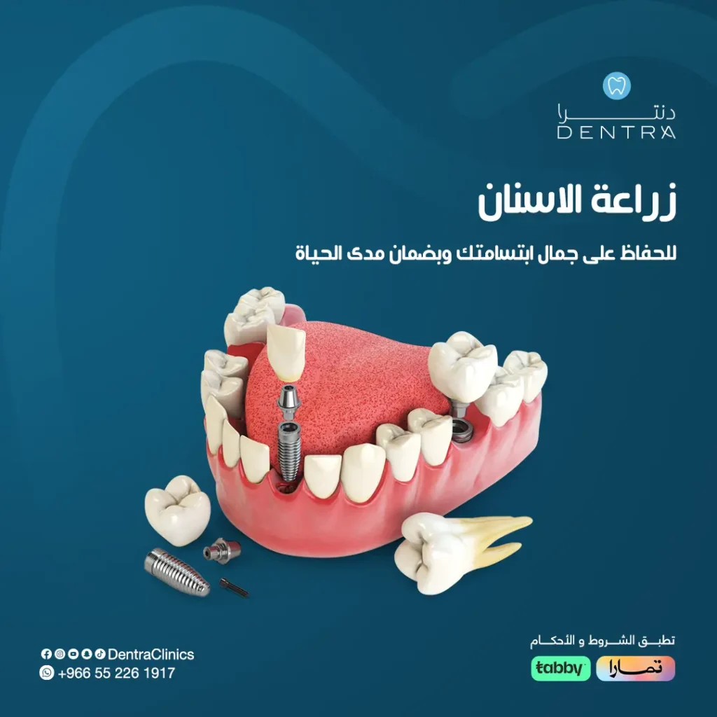 سعر زراعة الأسنان في السعودية