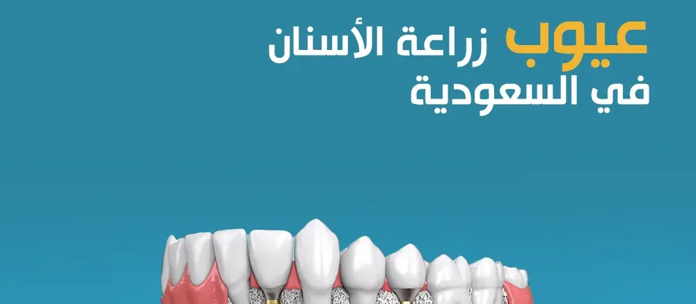 عيوب زراعة الأسنان في السعودية