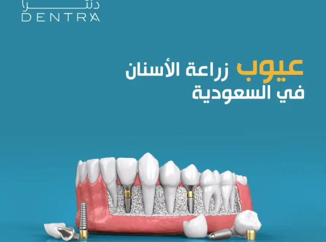 عيوب زراعة الأسنان في السعودية